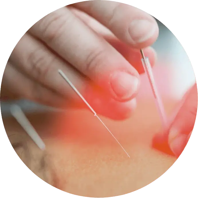 Acupuncture Services