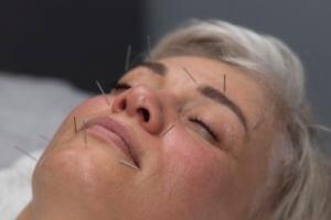 Everything You Need to Know About Facial Cosmetic Acupuncture